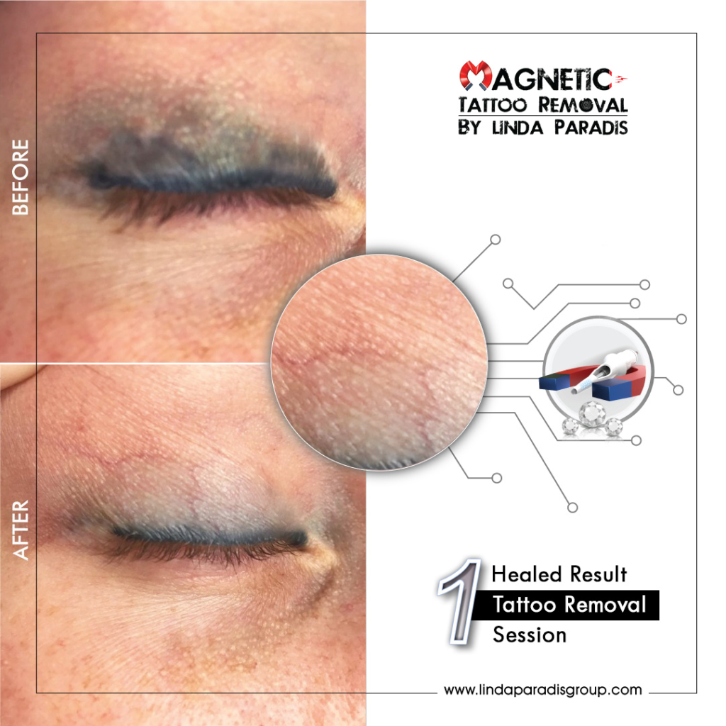 Magnetic Tattoo Removal before and after eyeliner tattoo removal Magnetic Tattoo Removal before and after eyeliner tattoo removal