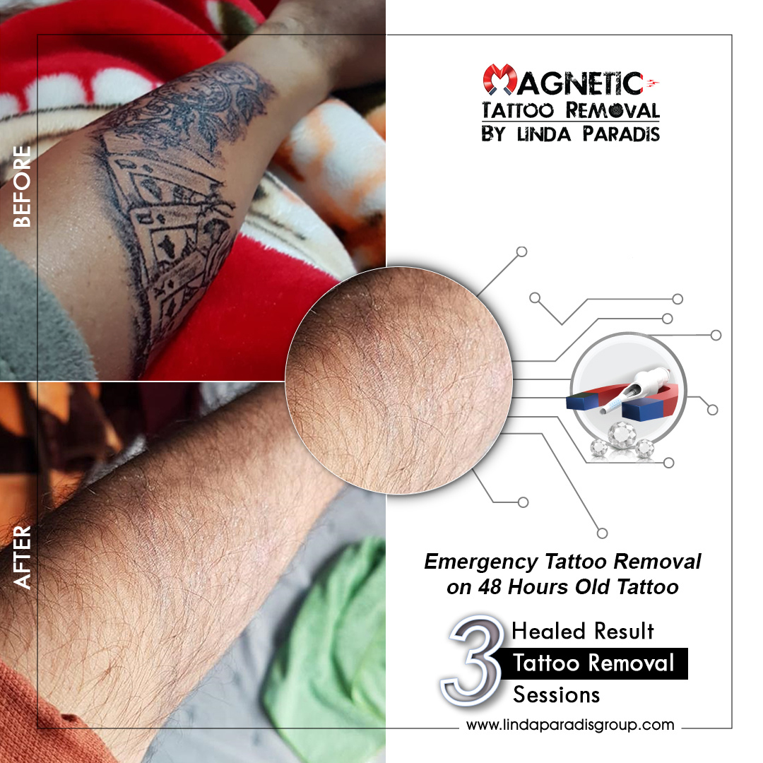 Magnetic Tattoo Removal before and after body tattoo removal